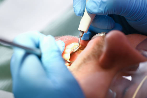 Best Emergency Tooth Extraction in Oak Forest, IL