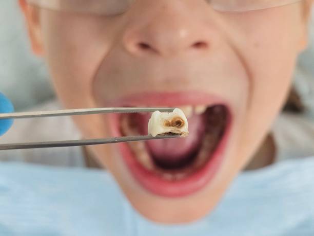 Best Emergency Tooth Extraction in Oak Forest, IL